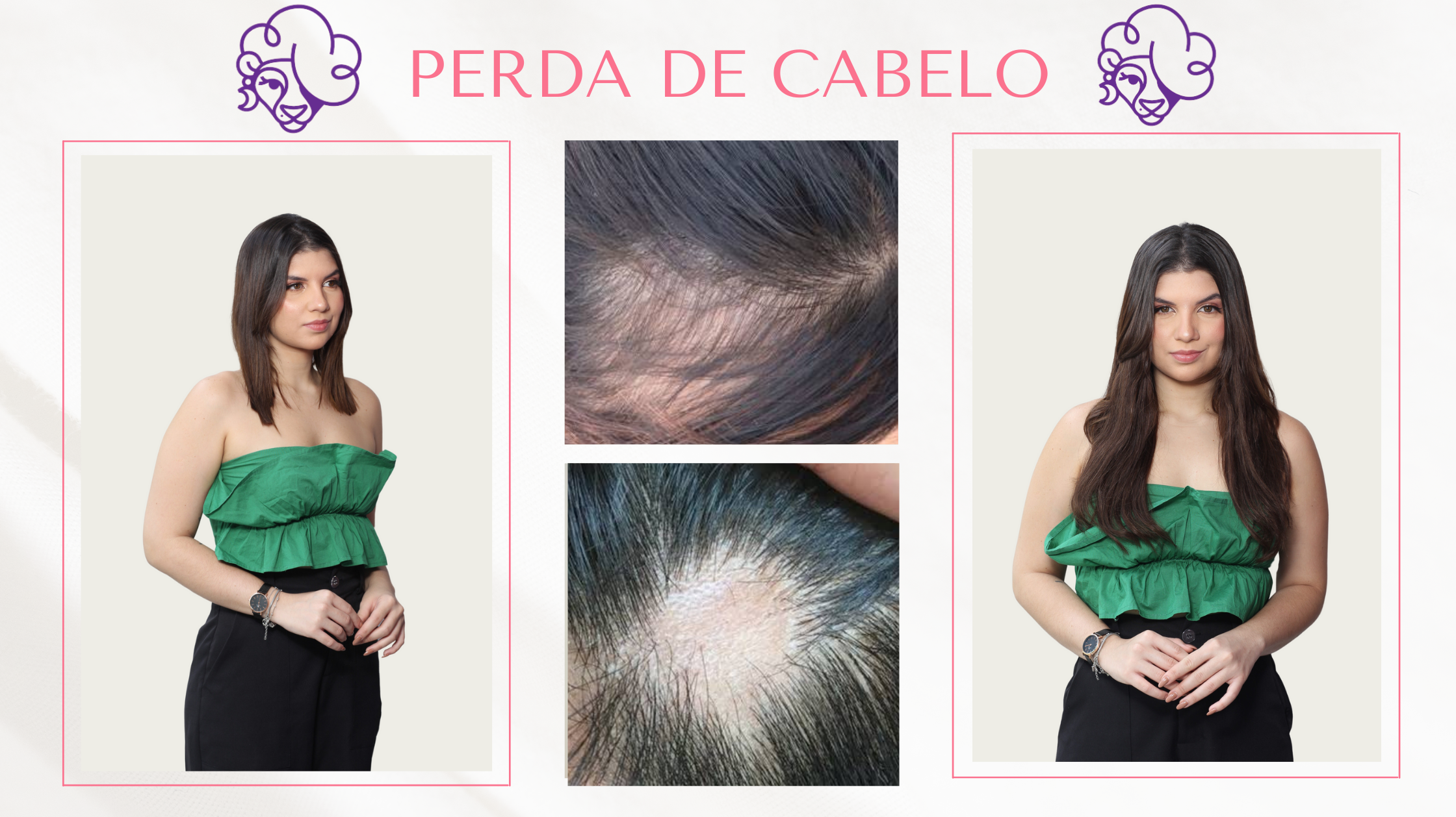 Perda de cabelos por conta da Covid, Alopecia, Eflúvio telógeno e Anágeno, e os Apliques de Tic Tac